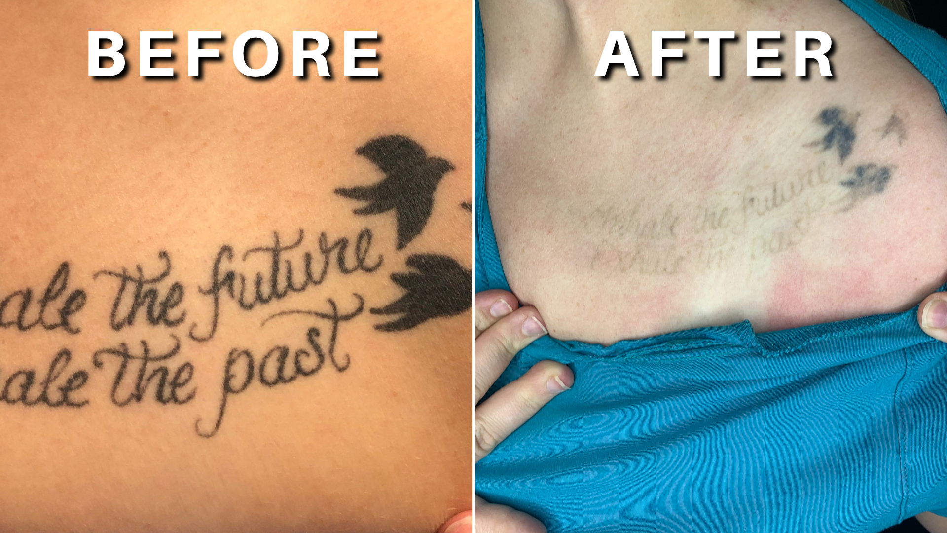 Home - DFW Tattoo Removal