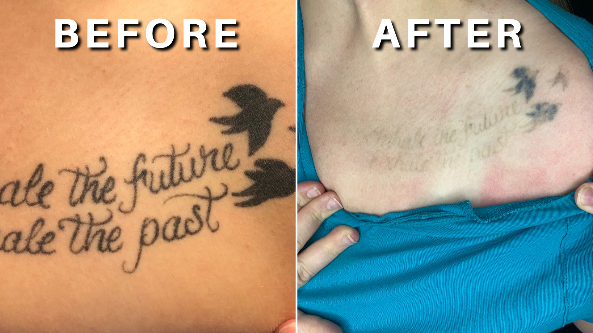 Before and after 4 treatments