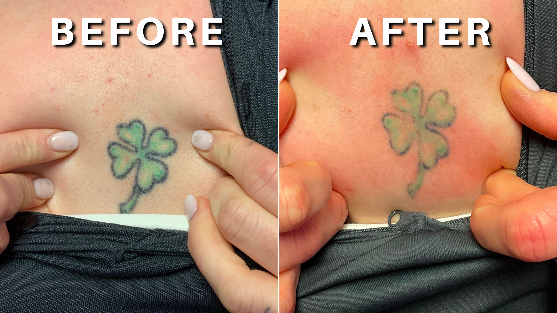 Tattoo Removal | Green Bay & Appleton WI | Hotchandani Laser Aesthetic