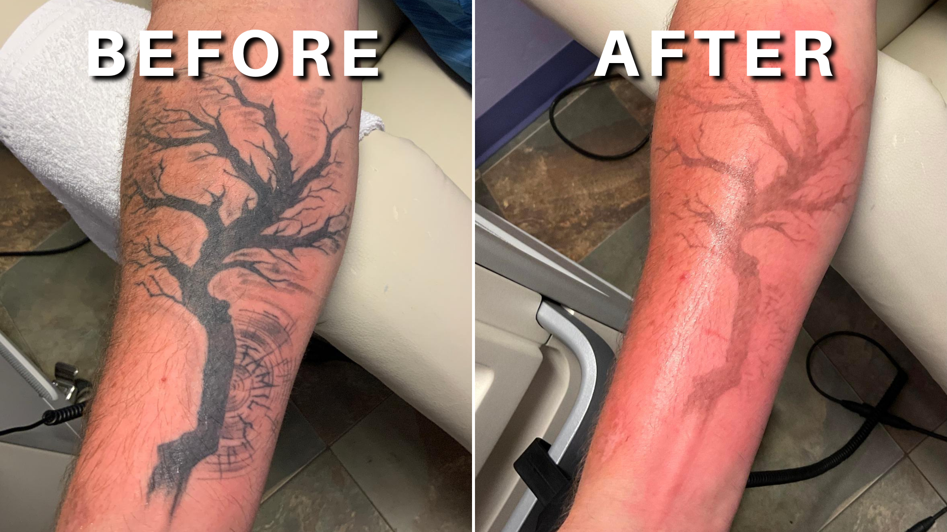 Before and After Gallery - DFW Tattoo Removal