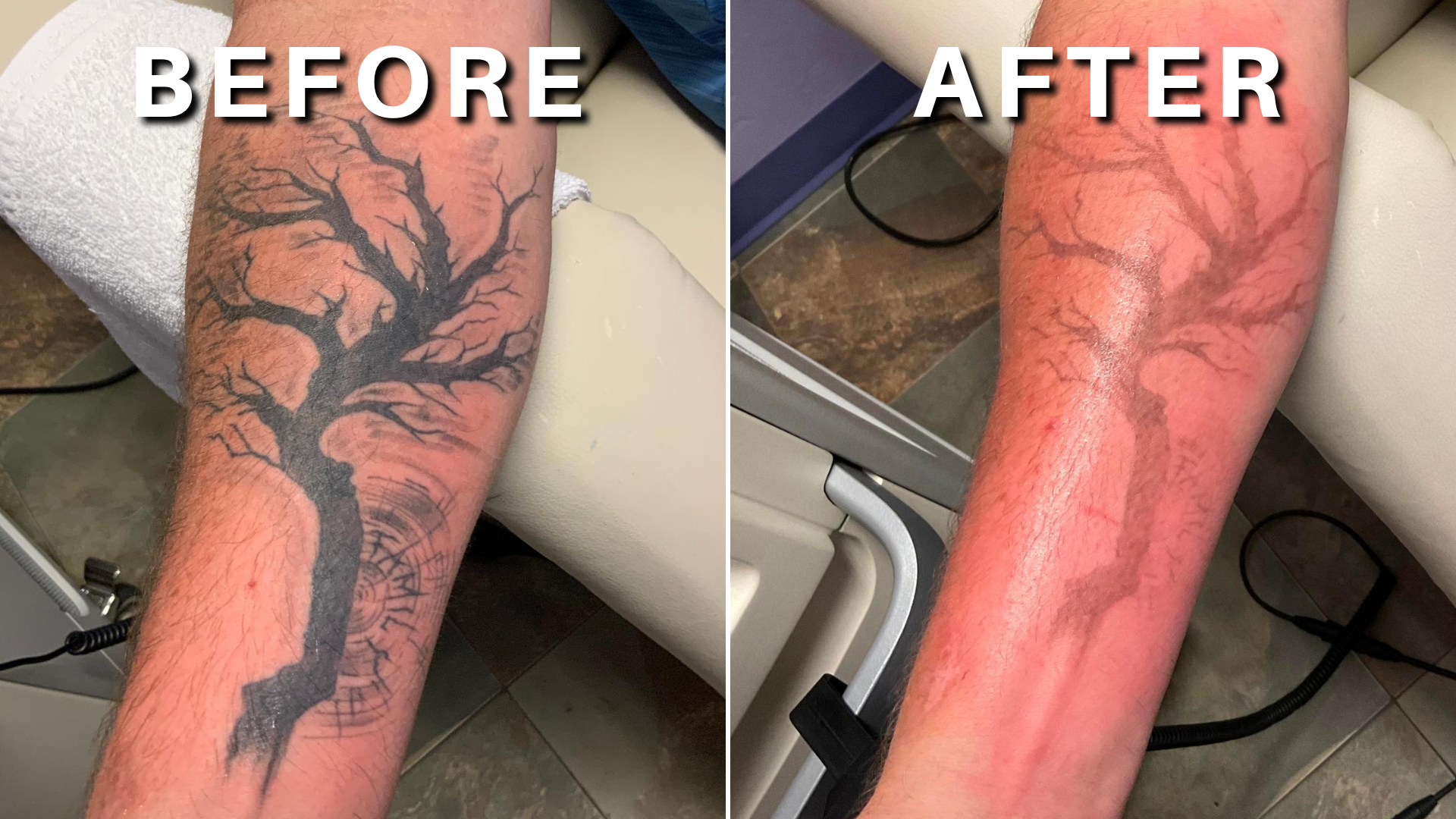 Can I get a Tattoo before or after Plastic Surgery? | CosMediTour