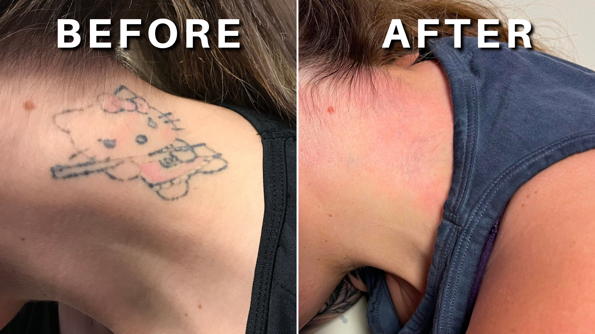 Before and after 6 treatments