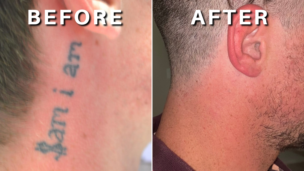 Laser Tattoo Removal - DFW Tattoo Removal
