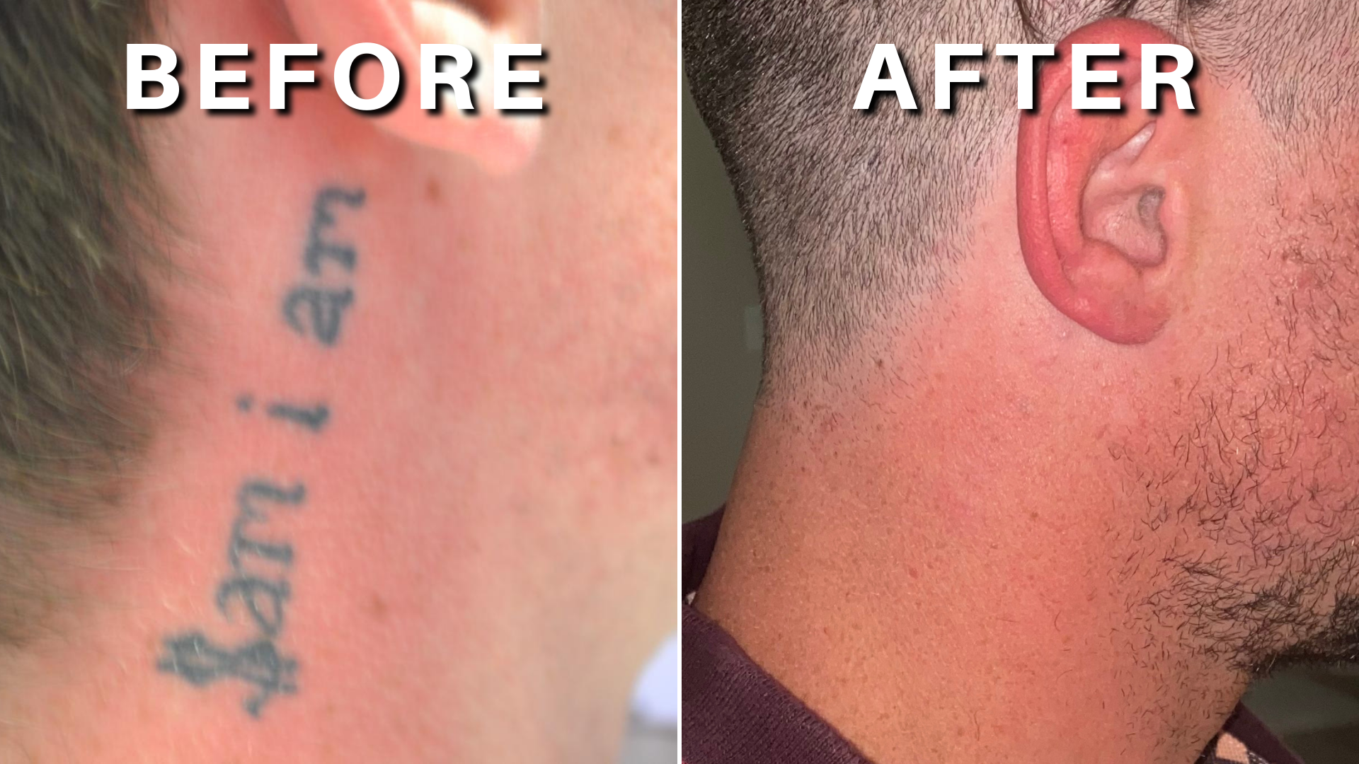Gallery - DFW Tattoo Removal