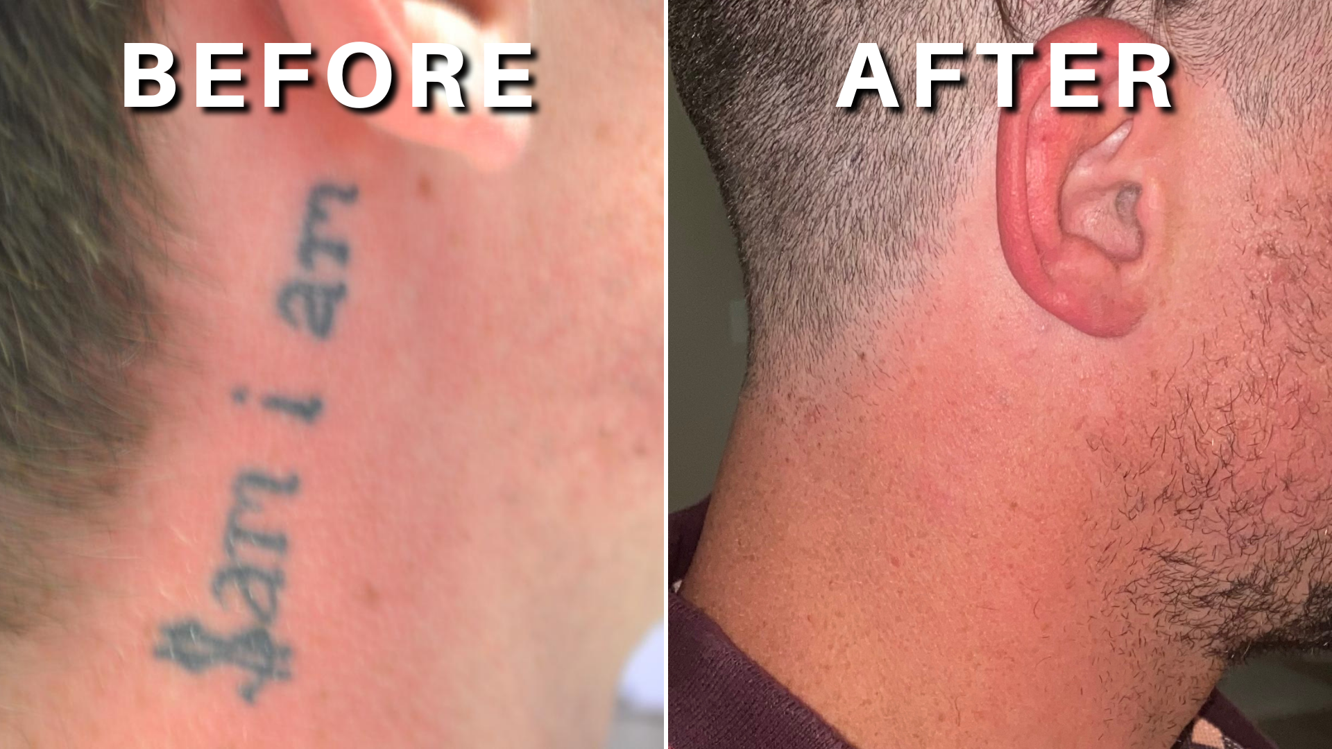 Dermabrasion Treatment for Tattoo Removal | Care Well Medical Centre